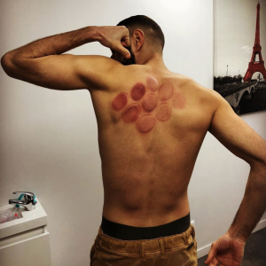 Karim Benzema est un adepte du cupping.