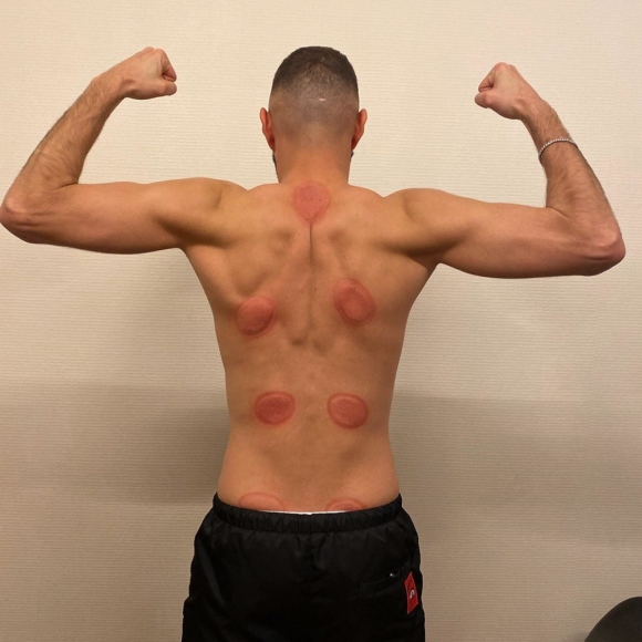 Karim Benzema est un adepte du cupping.