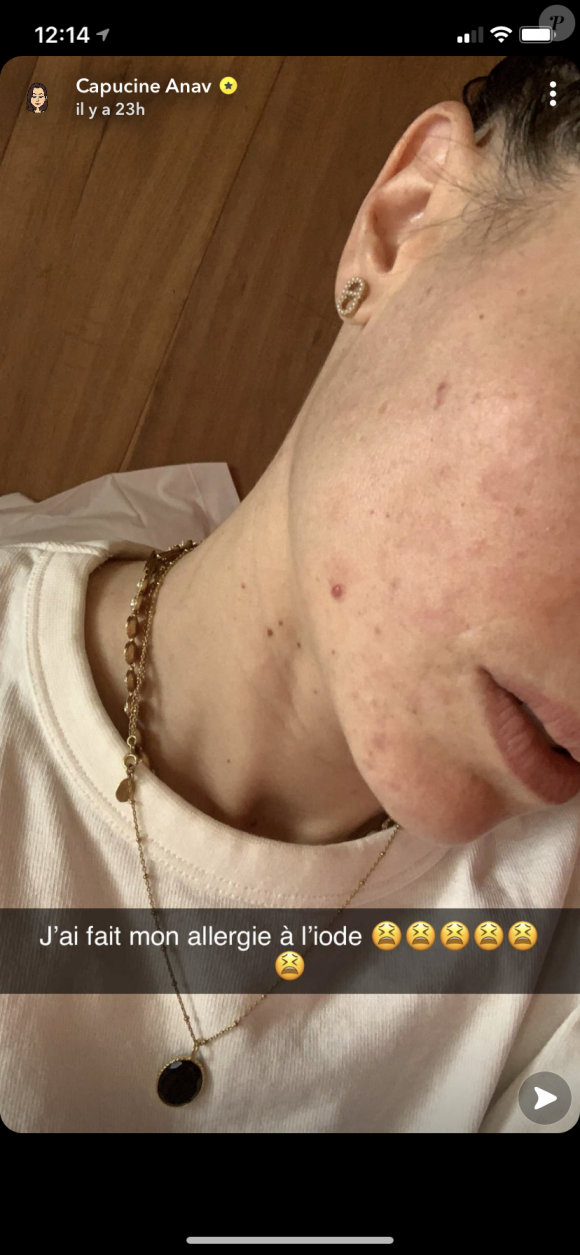 Capucine Anav dévoile son visage après avoir déclenché son "allergie à l'iode" - Snapchat, 28 décembre 2020