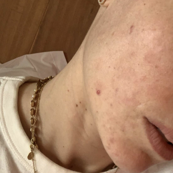 Capucine Anav dévoile son visage après avoir déclenché son "allergie à l'iode" - Snapchat, 28 décembre 2020