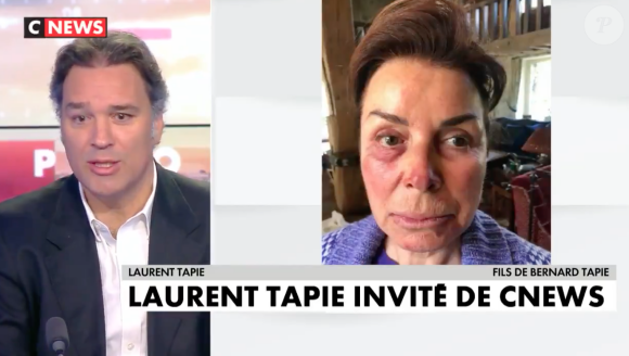 Les visages meurtris de Bernard Tapie et sa femme Dominique après leur agression survenue à leur domicile, en avril 2021.