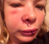 Cindy Poumeyrol dévoile une photo de son visage après avoir été mordue par un chien. Elle a eu 50 points de suture.