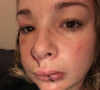Cindy, candidate de "Koh-Lanta", révèle ses blessures au visage suite à la morsire d'un chien. Octobre 2019.
