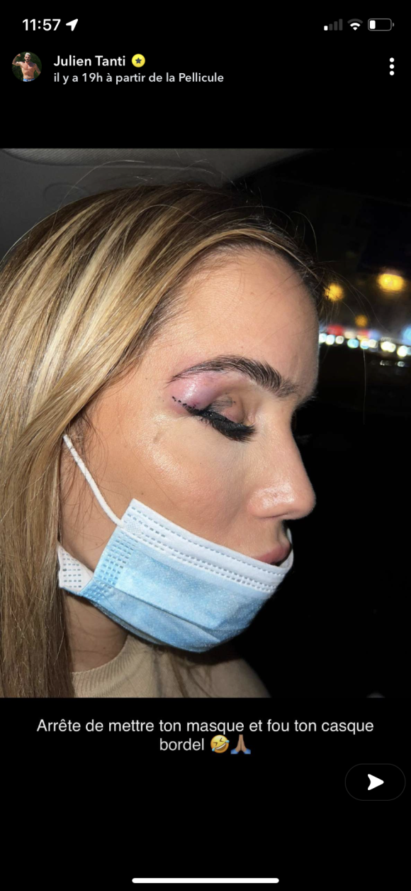 Manon Marsault dévoile son impressionnante blessure après s'être cognée - Snapchat