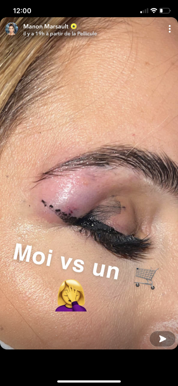 Manon Marsault dévoile son impressionnante blessure après s'être cognée - Snapchat