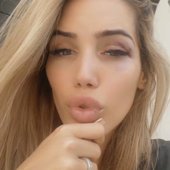 Manon Marsault dévoile son impressionnante blessure après s'être cognée - Snapchat