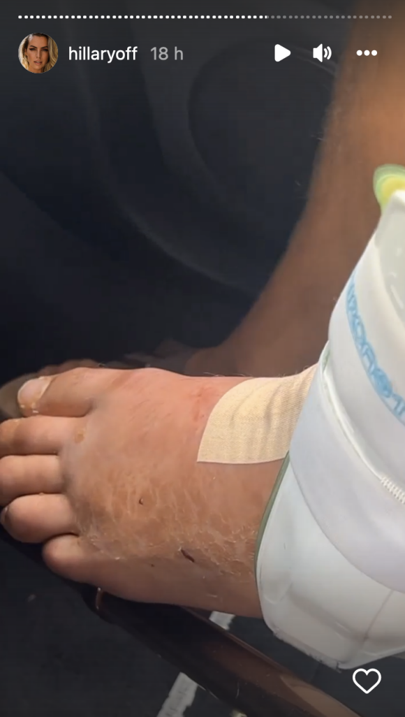 Hillary Vanderosieren partage des images du pied de Giovanni Bonamy juste après son accident de voiture - Instagram