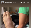 Giovanni Bonamy partage des images de son pied juste après son accident de voiture - Instagram