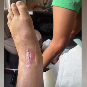 Giovanni Bonamy partage des images de son pied juste après son accident de voiture - Instagram