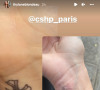 Thylane Blondeau s'est fait enlever un tatouage au laser. Story Instagram du 31 janvier 2022.