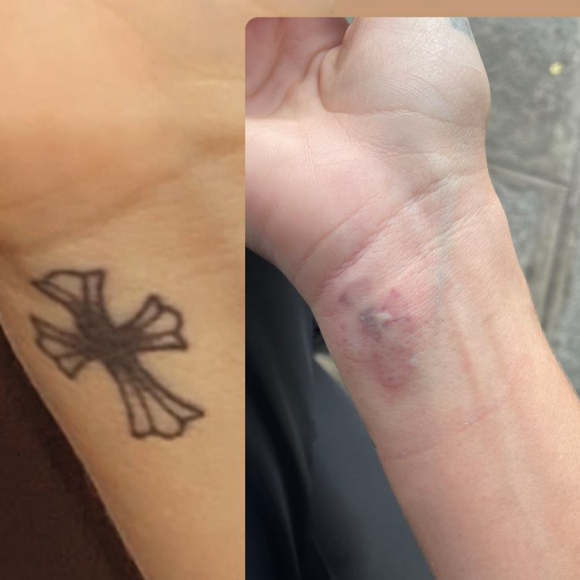 Thylane Blondeau s'est fait enlever un tatouage au laser. Story Instagram du 31 janvier 2022.