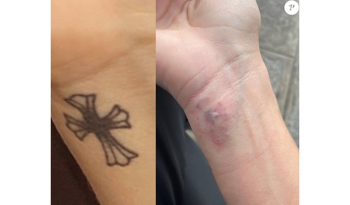 Thylane Blondeau s'efface (encore) un tatouage au laser, images inédites de son traitement