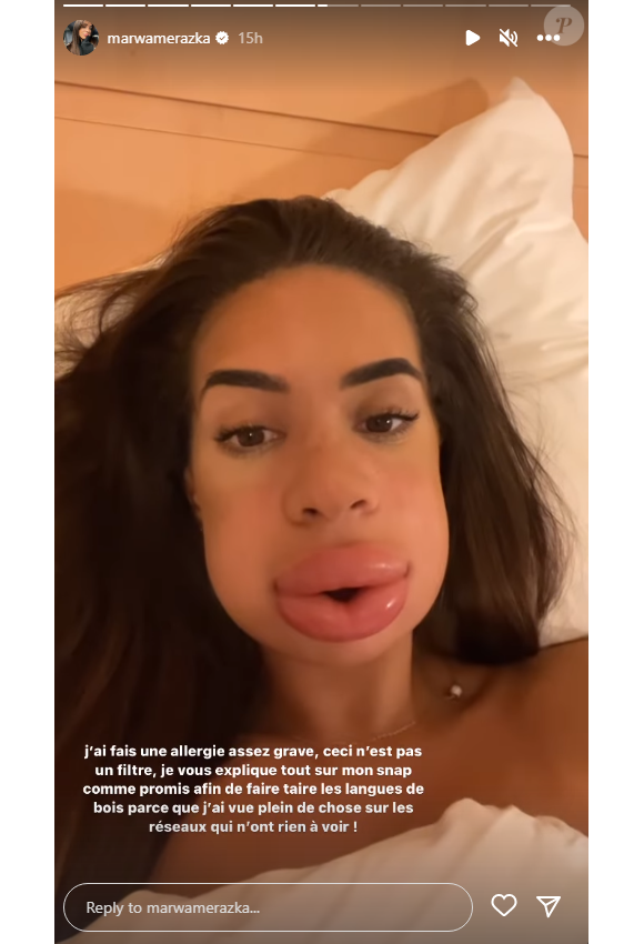 Marwa (Les Cinquante) révèle avoir fait une allergie à des injections et dévoile son visage complètement défiguré - Instagram