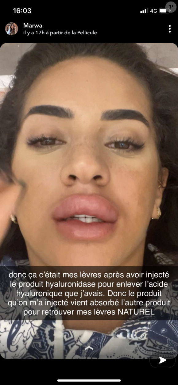 Marwa (Les Cinquante) le visage déformé après avoir eu recours à des injections - Snapchat