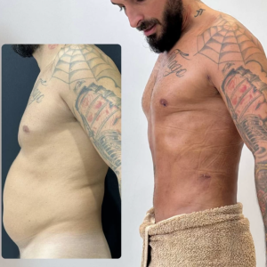 Le candidat lui-même n'en revient pas !
Julien Tanti dévoile l'extraordinaire avant/après de sa liposuccion sur Snapchat.