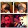 A.J. McLean montre des photos de lui avant et après avoir fait des implants capillaires fin 2011 sur Instagram le 30 mars 2013.
