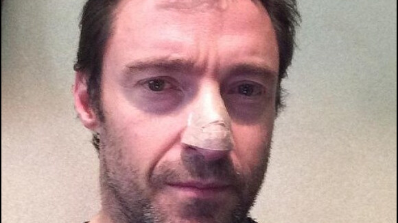 Hugh Jackman : L'acteur soigné pour un cancer de la peau !
