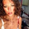 Lorie a posté une photo de son visage défiguré sur son compte Instagram. Le 10 mai 2014.