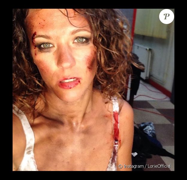 Lorie a posté une photo de son visage défiguré sur son compte Instagram. Le 10 mai 2014.