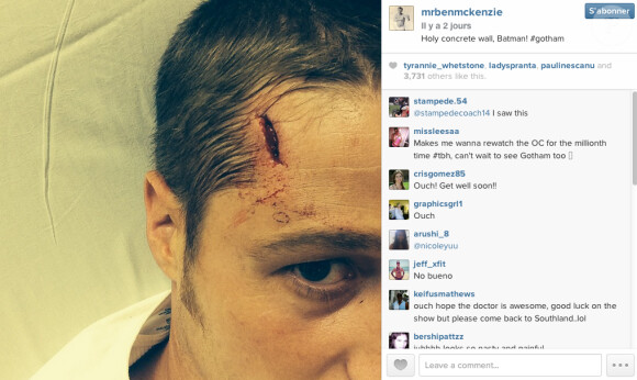 Benjamin McKenzie montre sa blessure sur le tournage de sa série "Gotham" le 12 septembre 2014.