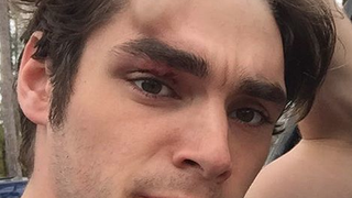 RJ Mitte (Breaking Bad), victime d'un accident : Le beau gosse bien amoché