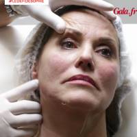 Sophie Favier : Botox et CoolSculpting... sa métamorphose continue !