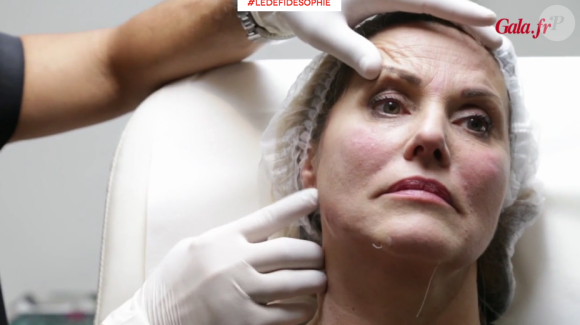 Sophie Favier se lance dans l'expérimentation du botox et du CoolSculpting pour Le Défi de Sophie avec Gala. Ici, place au botox !
