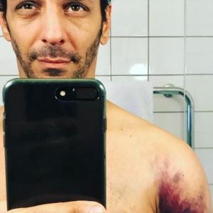 Tomer Sisley expose sa blessure sur Instagram. Le 28 mars 2017.