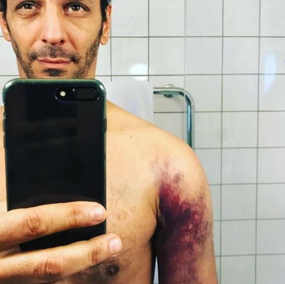 Tomer Sisley expose sa blessure sur Instagram. Le 28 mars 2017.