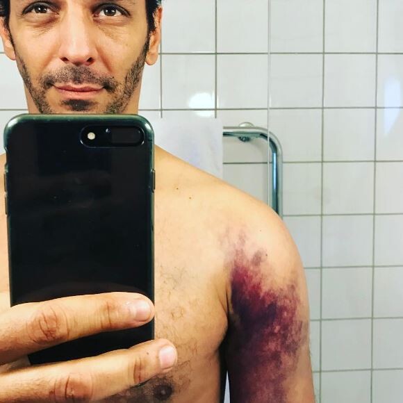 Tomer Sisley expose sa blessure sur Instagram. Le 28 mars 2017.
