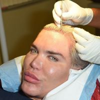 Rodrigo Alves : Le Ken humain s'achète des cheveux, une intervention sanglante