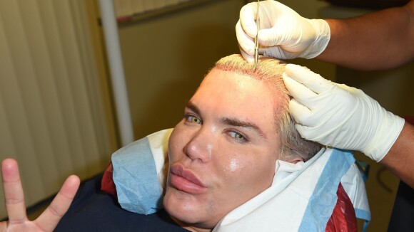Rodrigo Alves : Le Ken humain s'achète des cheveux, une intervention sanglante