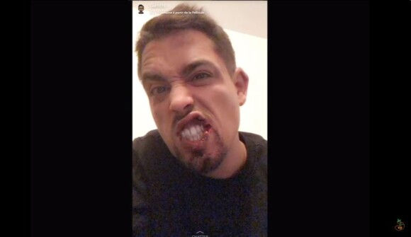 Lartiste apparaît le visage tuméfié sur Snapchat après son agression, 22 mars 2018