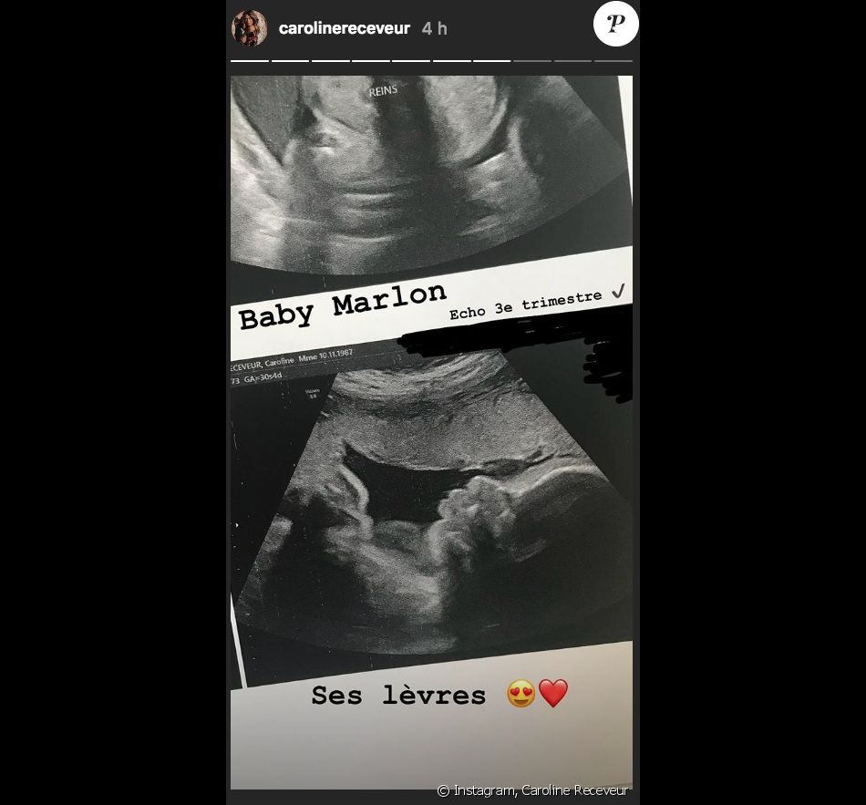Caroline Receveur Devoile L Echographie De Son Bebe Marlon Le 11 Mai 18 Purepeople