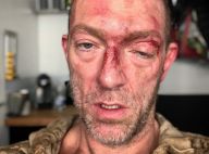 Vincent Cassel bien amoché : Il dévoile son visage tuméfié et décharné