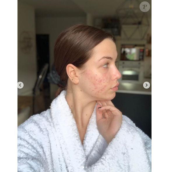 EnjoyPhoenix, youtubeuse souffrant d'acné hormonale, se dévoile entièrement au naturel sur Instagram, le 12 mai 2019.