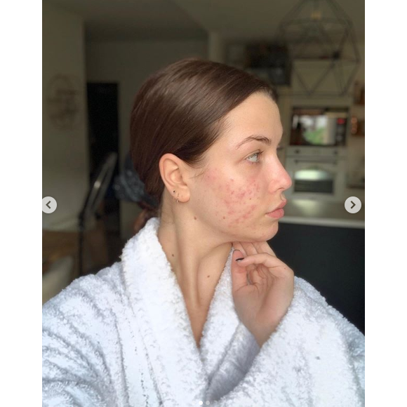 EnjoyPhoenix, youtubeuse souffrant d'acné hormonale, se dévoile entièrement au naturel sur Instagram, le 12 mai 2019.