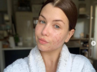 EnjoyPhoenix : Selfie 100% naturel pour dévoiler son acné, "de pire en pire"