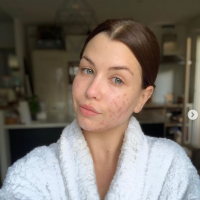 EnjoyPhoenix : Selfie 100% naturel pour dévoiler son acné, "de pire en pire"