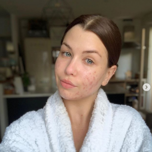 EnjoyPhoenix, youtubeuse souffrant d'acné hormonale, se dévoile entièrement au naturel sur Instagram, le 12 mai 2019.
