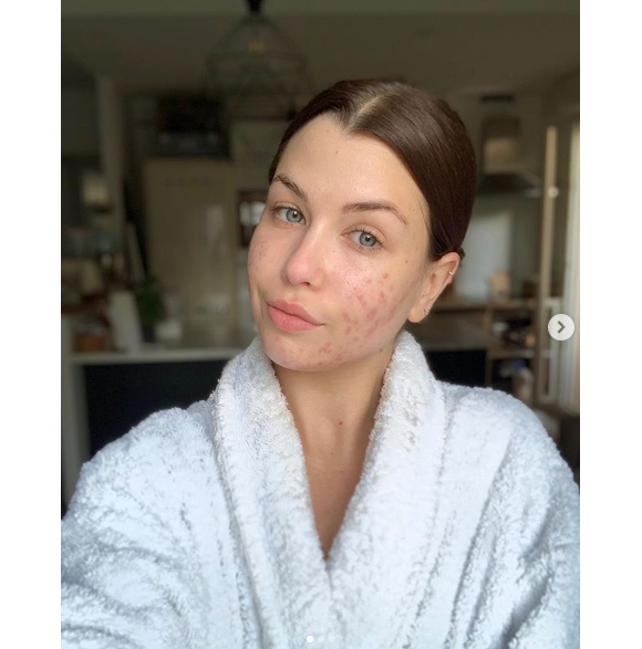 EnjoyPhoenix, youtubeuse souffrant d'acné hormonale, se dévoile entièrement au naturel sur Instagram, le 12 mai 2019.