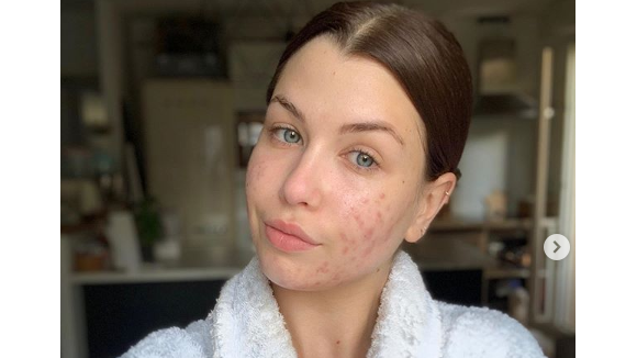 EnjoyPhoenix : Selfie 100% naturel pour dévoiler son acné, "de pire en pire"