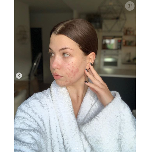 EnjoyPhoenix, youtubeuse souffrant d'acné hormonale, se dévoile entièrement au naturel sur Instagram, le 12 mai 2019.