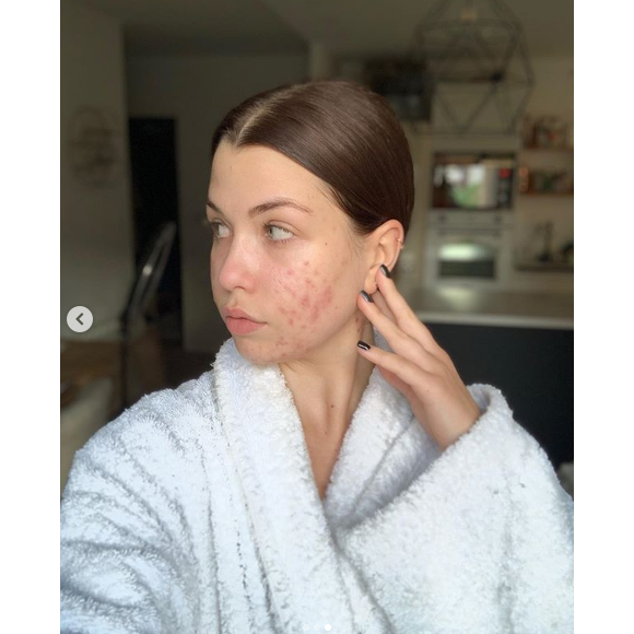 EnjoyPhoenix, youtubeuse souffrant d'acné hormonale, se dévoile entièrement au naturel sur Instagram, le 12 mai 2019.