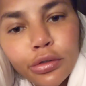 Chrissy Teigen : Victime d'un angio-oedème à la bouche le 16 août 2019.