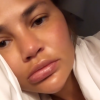 Chrissy Teigen : Victime d'un angio-oedème à la bouche le 16 août 2019.