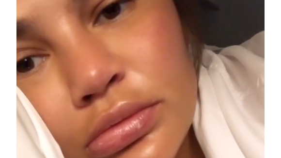 Chrissy Teigen défigurée à cause d'une allergie : "Mes lèvres vont exploser !"