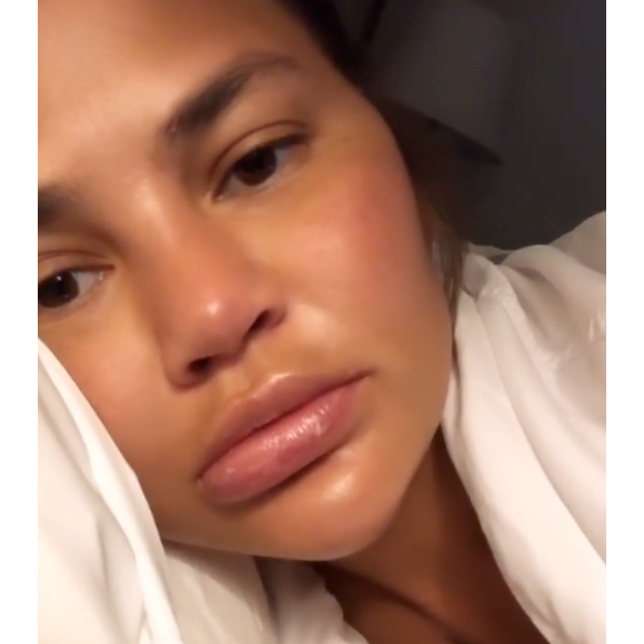 Chrissy Teigen : Victime d'un angio-oedème à la bouche le 16 août 2019.