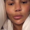 Chrissy Teigen : Victime d'un angio-oedème à la bouche le 16 août 2019.