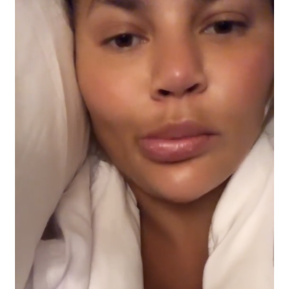 Chrissy Teigen : Victime d'un angio-oedème à la bouche le 16 août 2019.